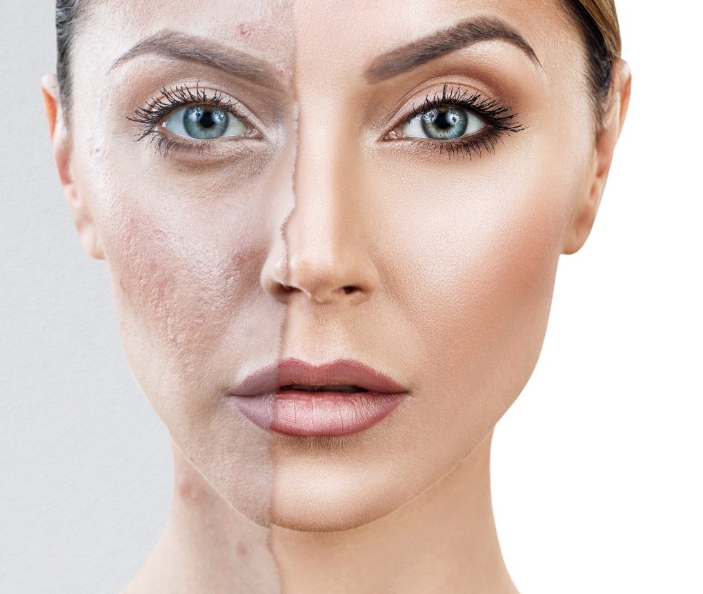 افضل كريم اساس للبشرة المعرضة لحب الشباب والحساسة