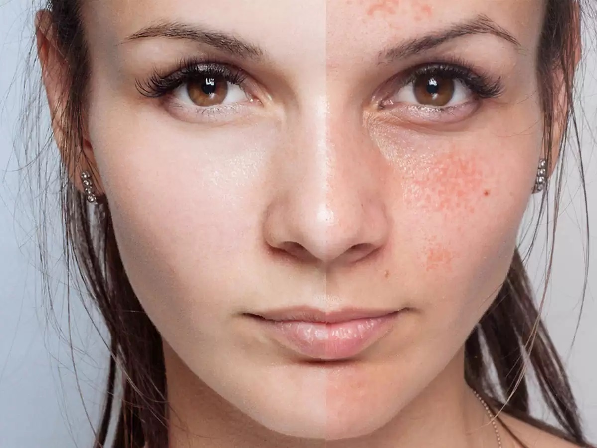 4 حيل لتطبيق ماسك البطاطس للحصول على بشرة وجه ناعمة ومشرقة قبل الزفاف