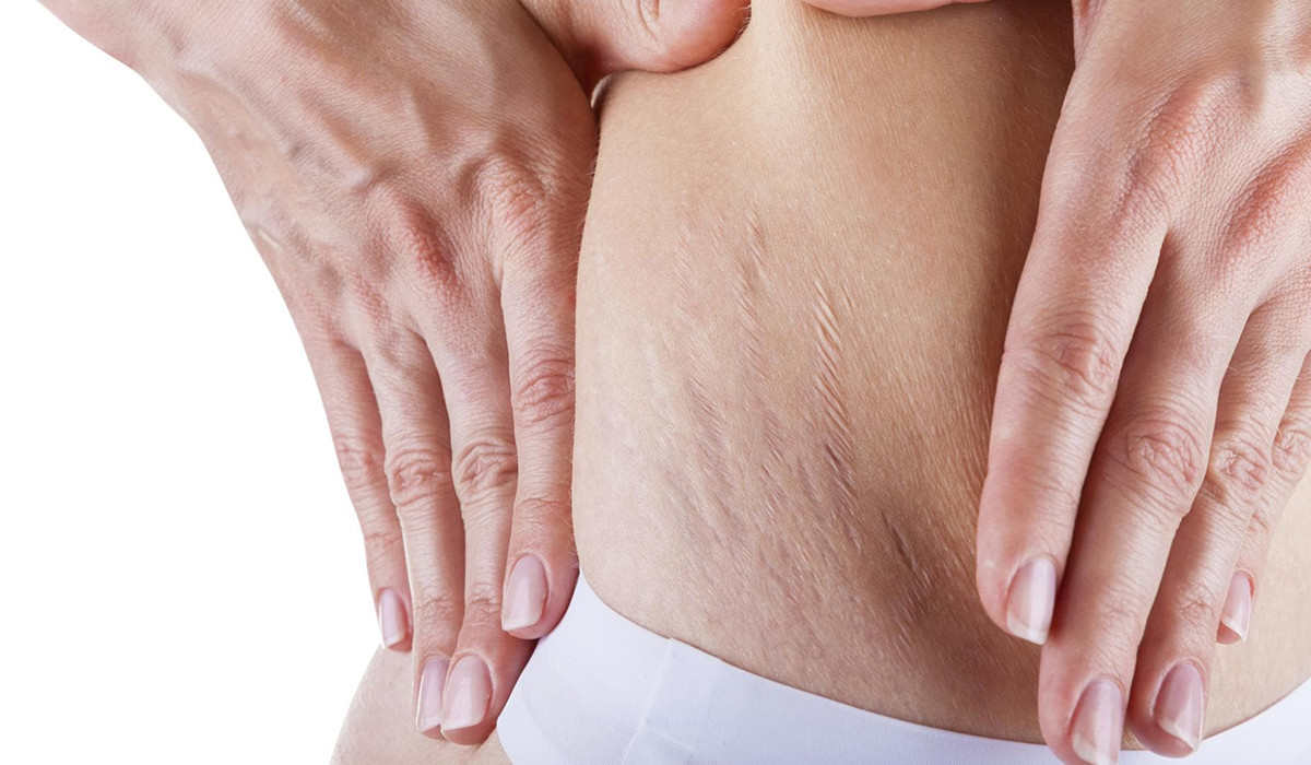 علاج علامات تمدد الجلد … طرق فعالة ومجربة