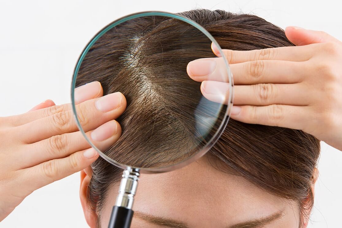  أفضل الوصفات لتنظيف فروة الرأس من الرواسب