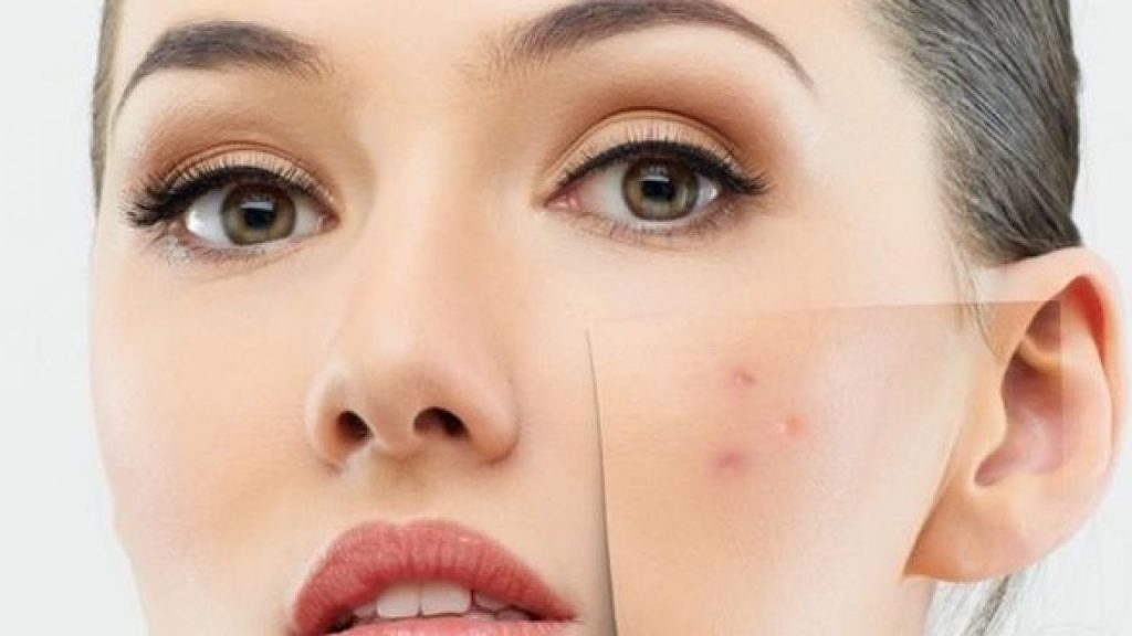 ماسكات لإزالة آثار حب الشباب فعالة ومجربه
