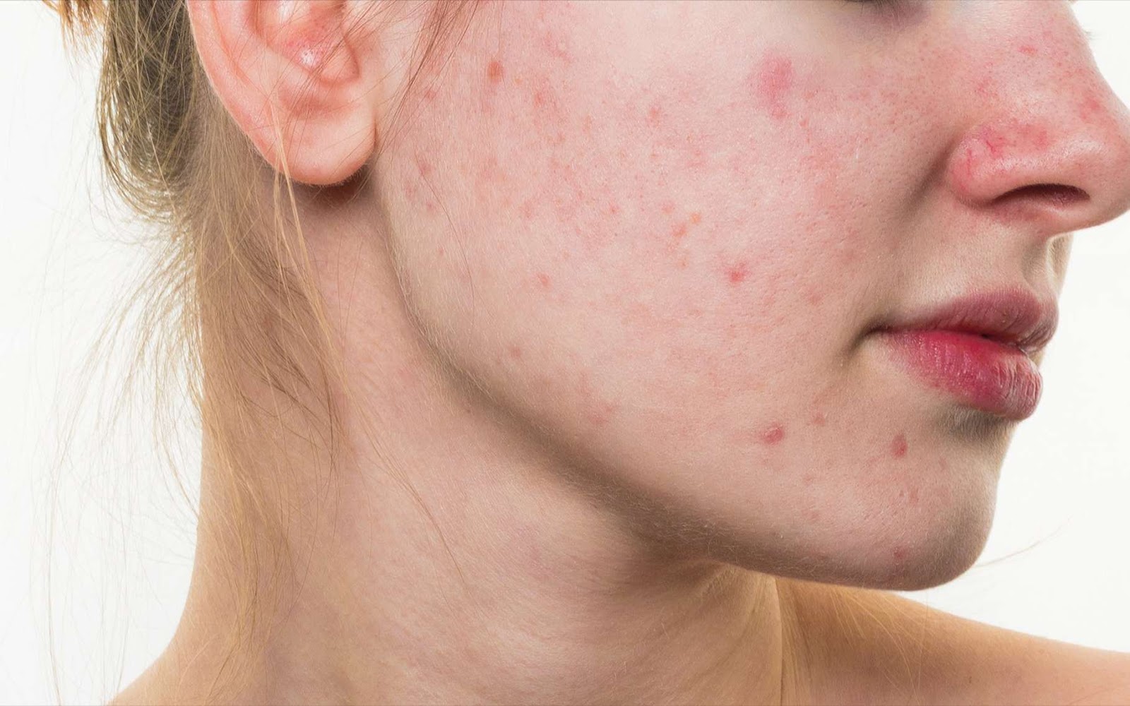 أفضل الأقنعة لإزالة حب الشباب… أهمها الكركم والأفوكادو