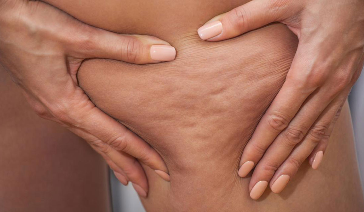 خطوات روتينية سهلة لمحاربة سيلوليت البشرة!