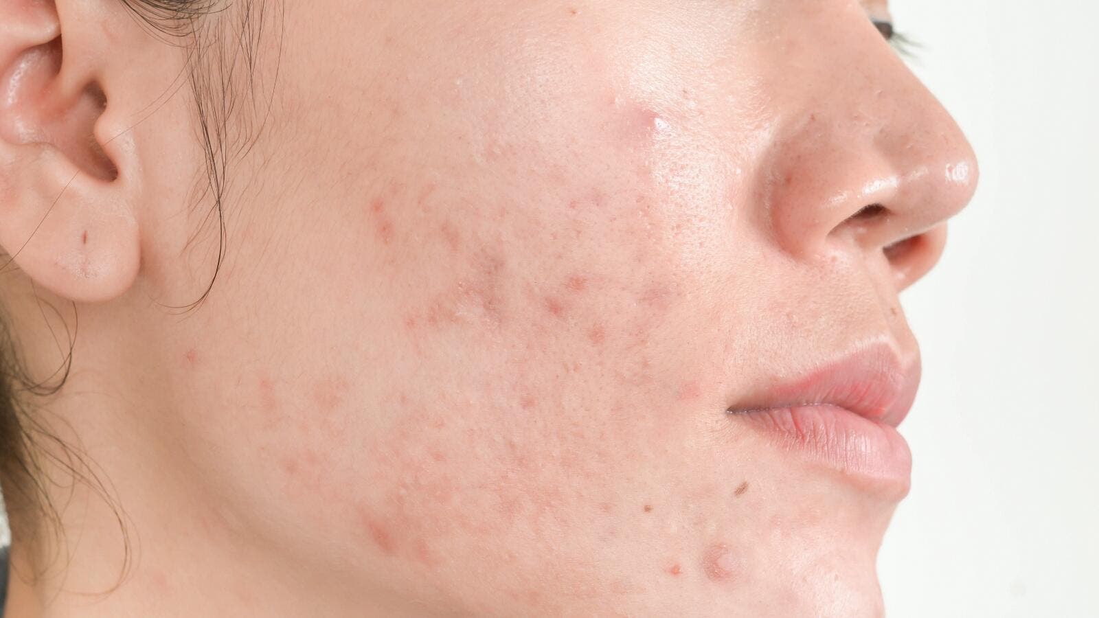 3 علاجات منزلية للقضاء على حفر الوجه