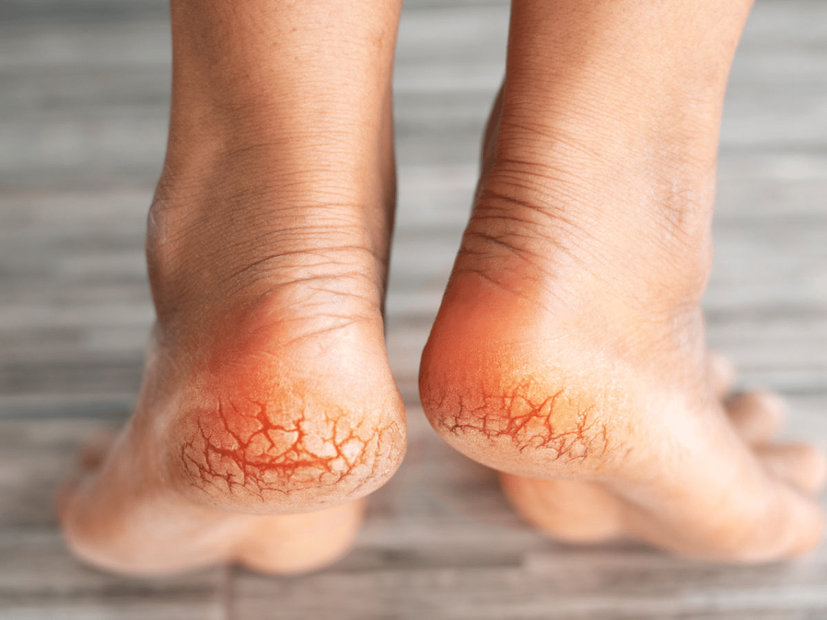 4 علاجات منزلية لأقدام بدون شقوق في الخريف!