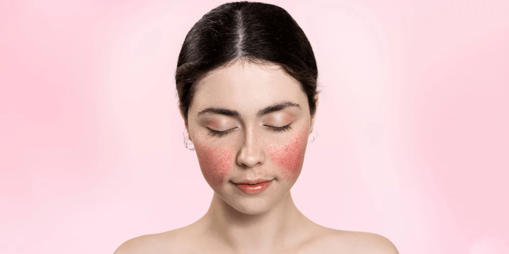 تعانين من العد الوردي ؟ إليك طريقة تطبيق المكياج