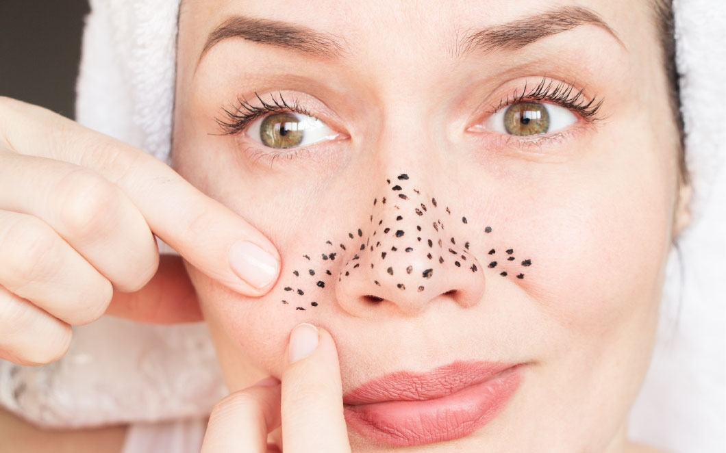 تخلصي من الرؤوس السوداء بمواد من مطبخك!