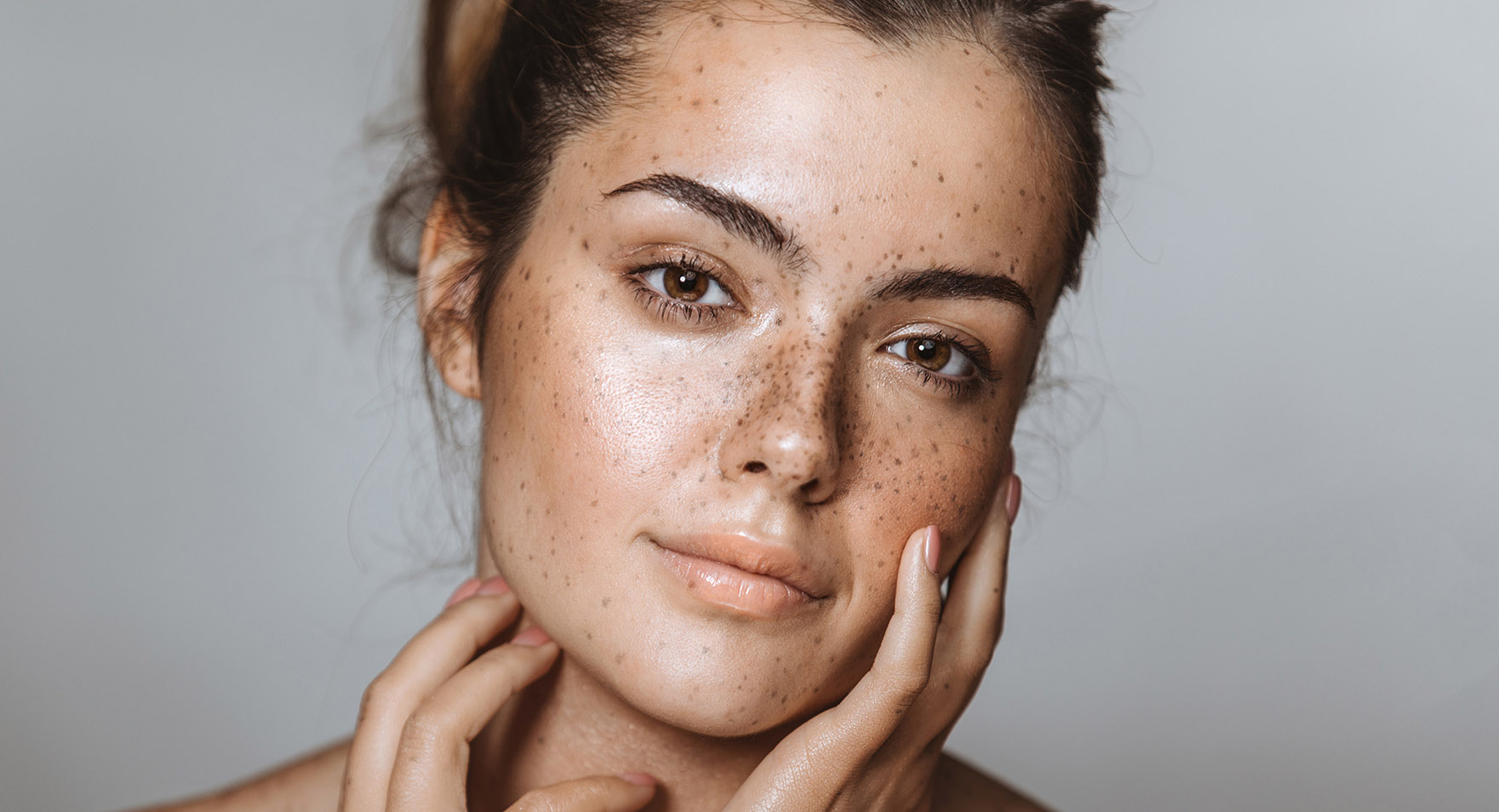 إزالة النمش من البشرة