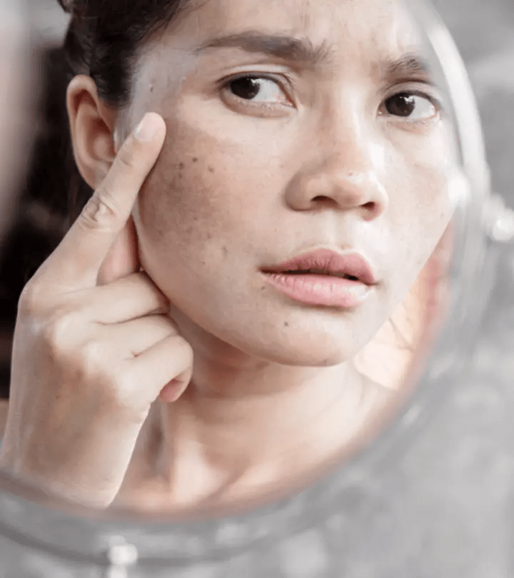 تخلصي من بقع الشمس قبل حفل زفافك نهائيًا