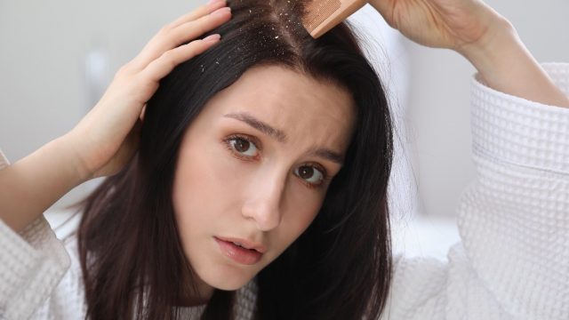 خلطات طبيعية لعلاج قشرة الرأس نهائيًا