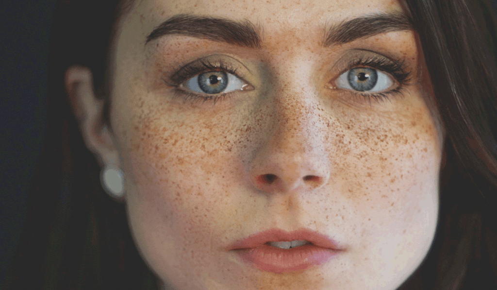 النمش : الأساليب الوقائية وأفضل الوصفات الطبيعية