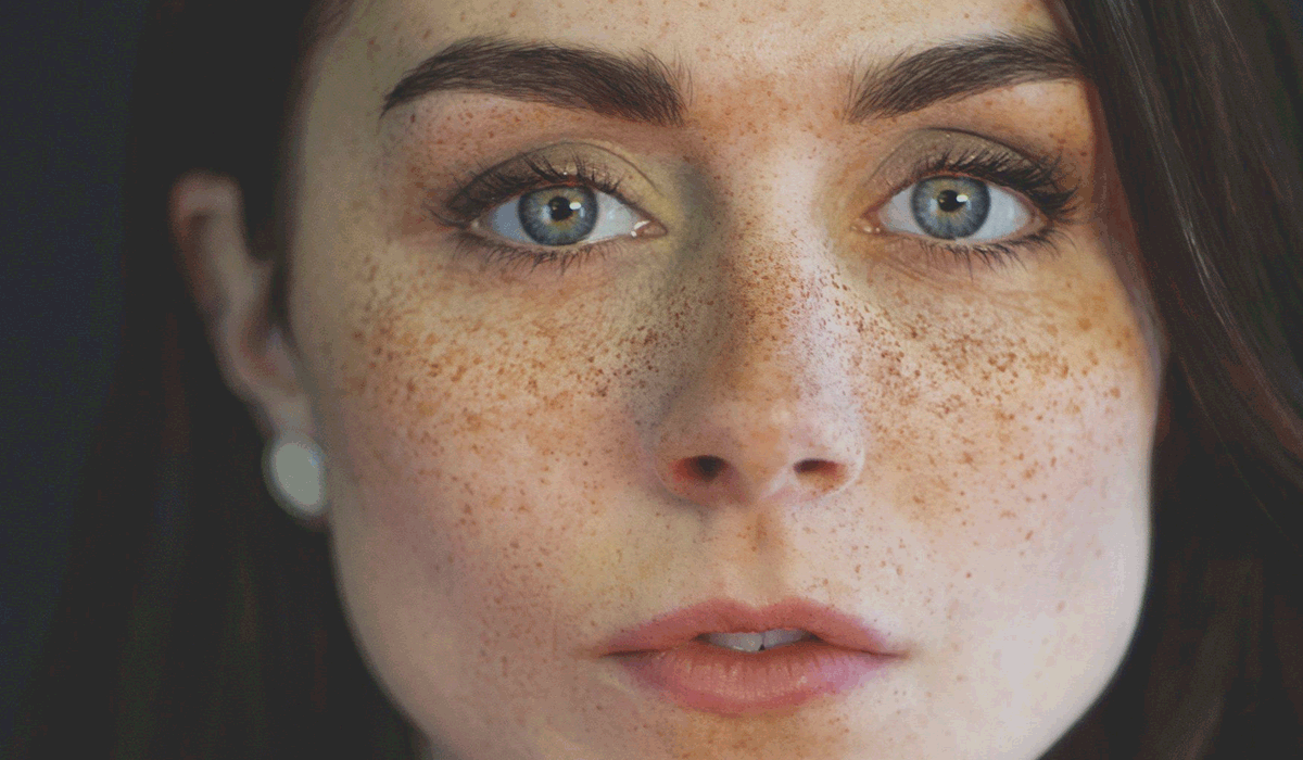 النمش : الأساليب الوقائية وأفضل الوصفات الطبيعية