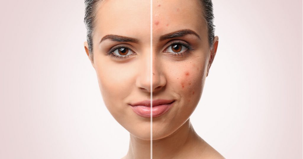 خلطات لعلاج حب الشباب : حلول فعالة لبشرة نقية وصحية