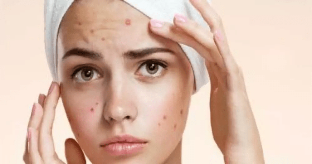 وصفات للتخفيف من حب الشباب