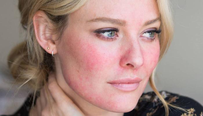 وصفات طبيعية للعناية بالبشرة الحساسة في الشتاء